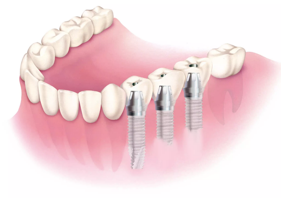 インプラント治療