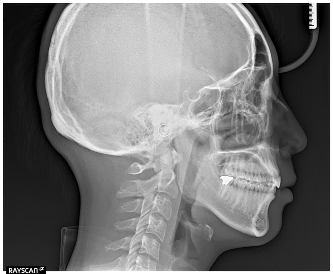 最新CTスキャナー導入